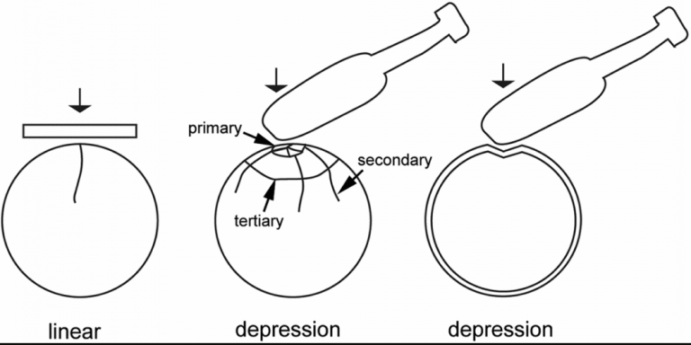 Blunt Force Trauma: Definition, Symptoms & Examples